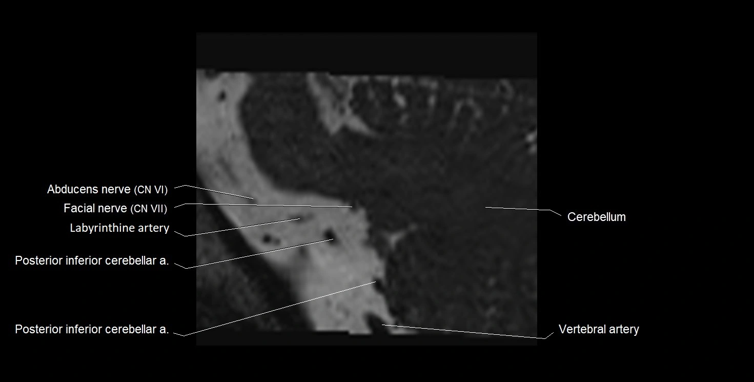 Internal auditory meatus (IAM) 3T sagittal cross sectional anatomy image 46.webp